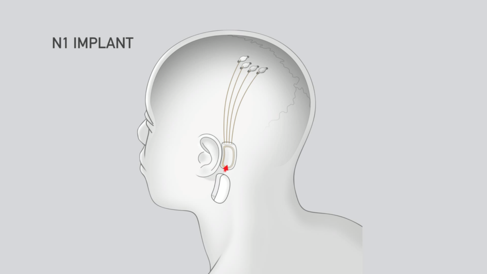 Илон Маск: Neuralink вживила в мозг обезьяны чип, позволяющий играть в видеоигры - 1