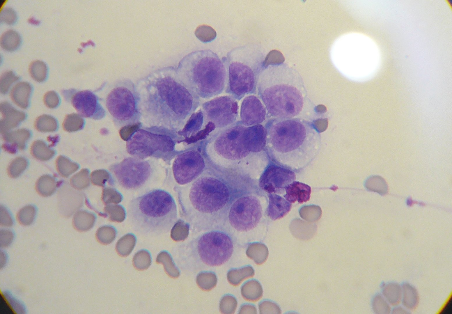  Cytology from a needle aspiration biopsy of a canine transmissible  venereal tumor.  Slide was stained with a modified Wright's stain.