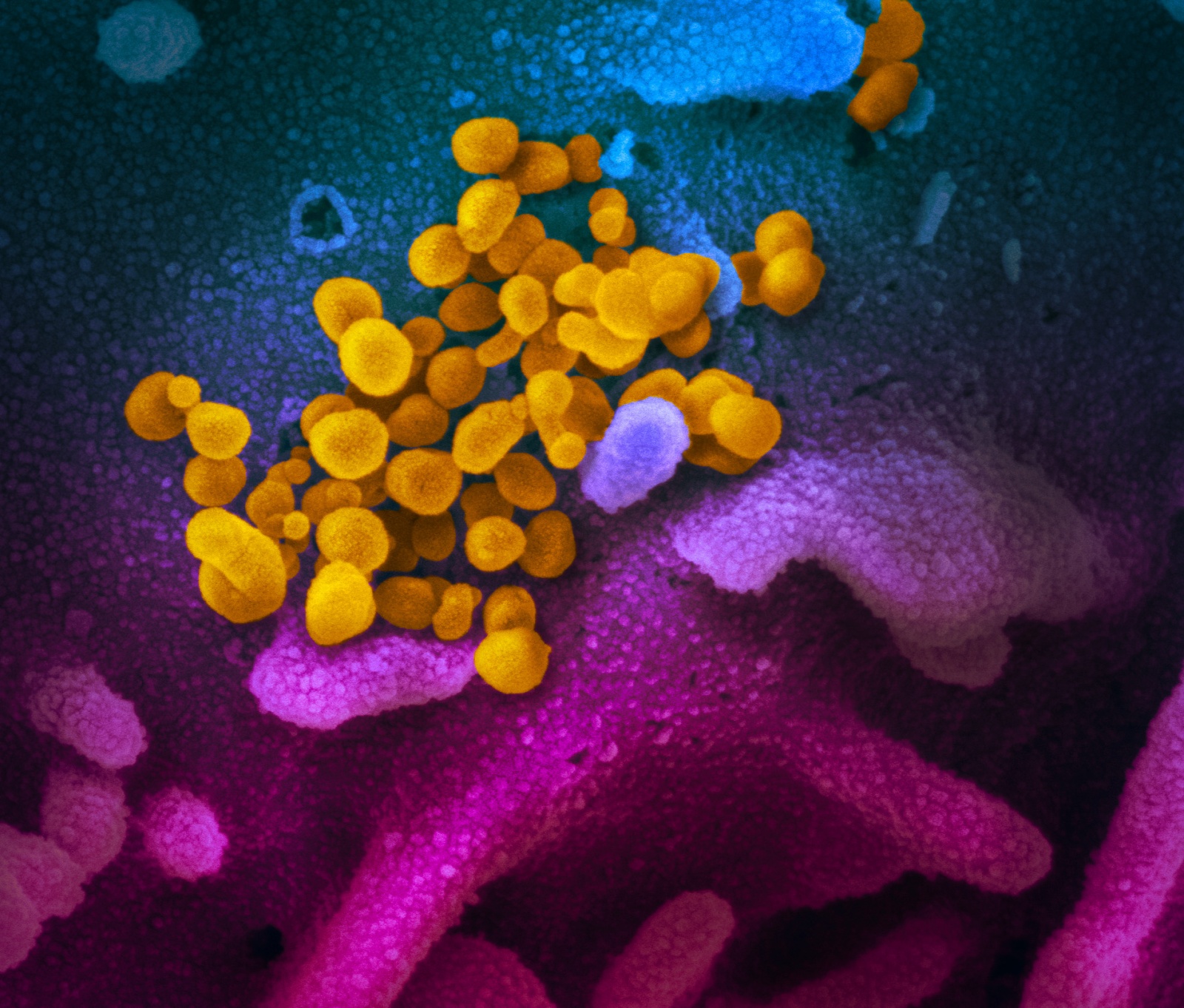 Novel Coronavirus SARS-CoV-2: This scanning electron microscope  image shows SARS-CoV-2 (yellow)—also known as 2019-nCoV, the virus that  causes COVID-19—isolated from a patient in the U.S., emerging from the  surface of cells (blue/pink) cultured in the lab. Credit: NIAID-RML