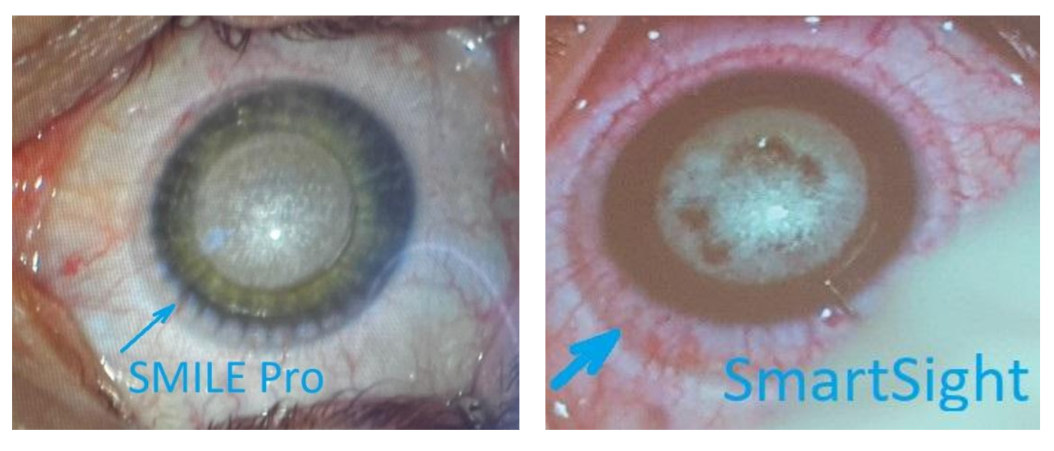 Состояние роговицы после SMILE Pro и после SmartSight