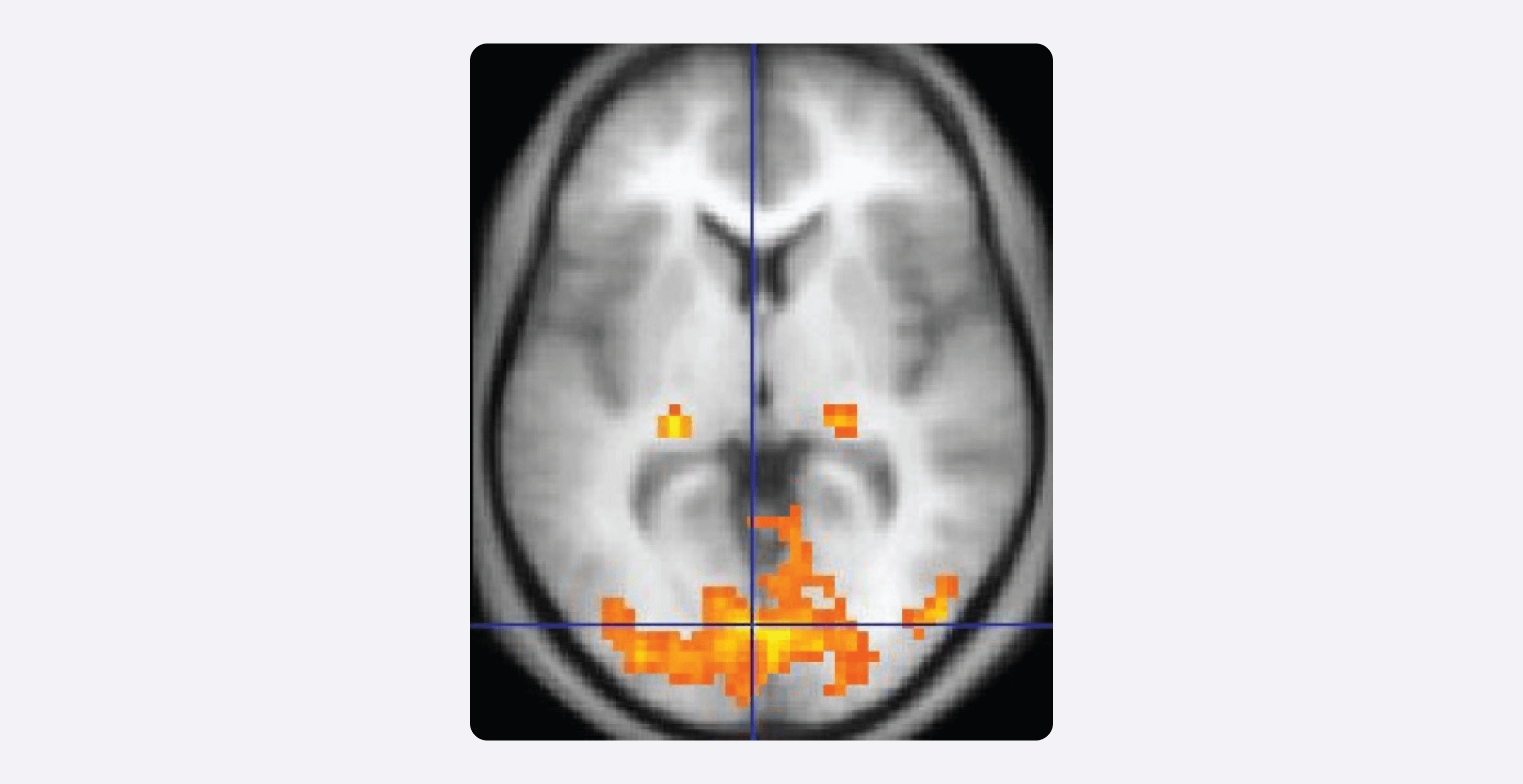 Пример изображения, полученного с помощью фМРТ (из учебника OpenStax Anatomy and Physiology). Подсвеченные области — это зоны повышенной активности.