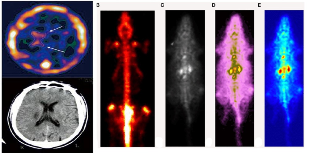 Слева: стрелками на SPECT-изображении показаны последствия правостороннего инсульта (ниже – МРТ-снимок). Изображения B –E: если можно сделать экспозицию более длинной, то детализация SPECT-изображения возрастает (снимок крысы с введенным лигандом иода-123 через сутки (В), и через час с разными цветовыми фильтрами (С – Е)).